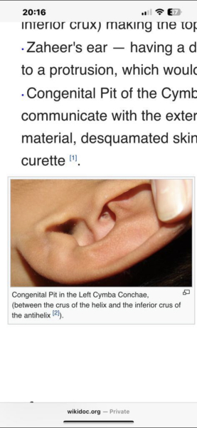 Baby has a hole in her ear