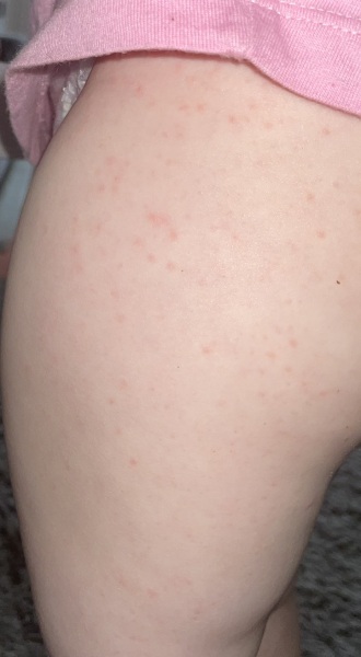 Rash
