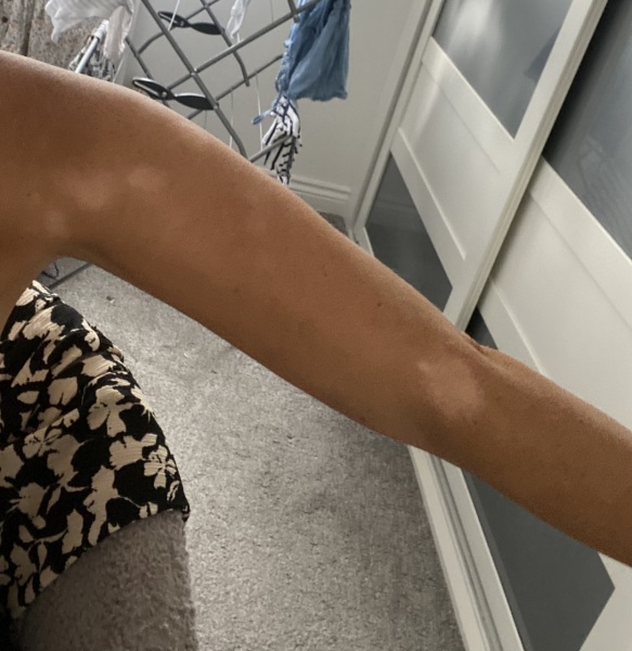 What has happened to my skin off the sun?