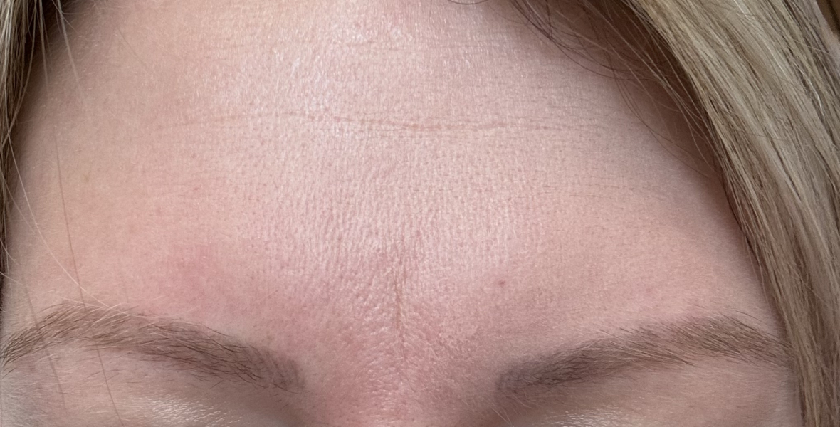 Botox for 11 lines