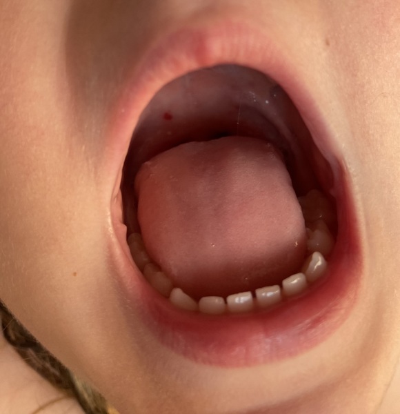 What is this on roof of DD's mouth...