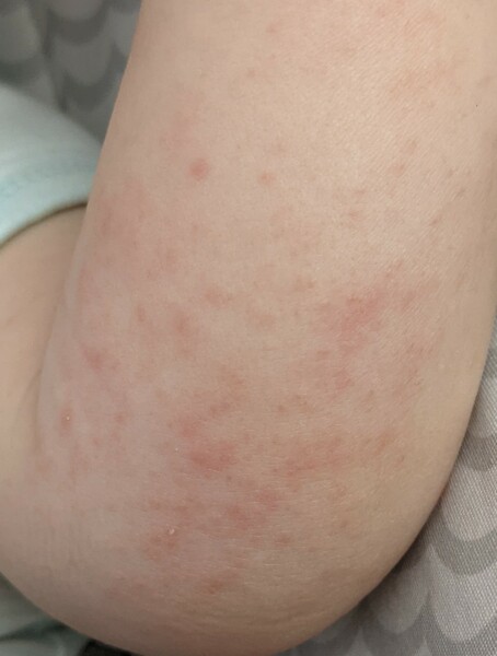 Eczema help needed