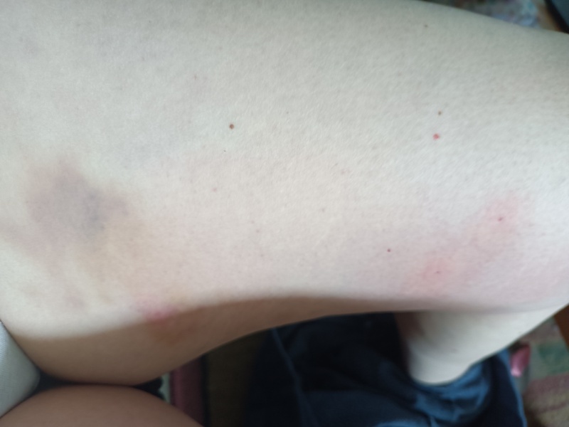 Insect bites