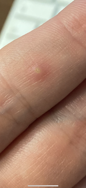 Verruca, boil, wart or stuck splinter/thorn?