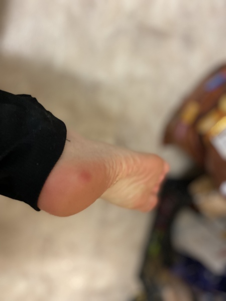 What is this on my foot? Sore red lump