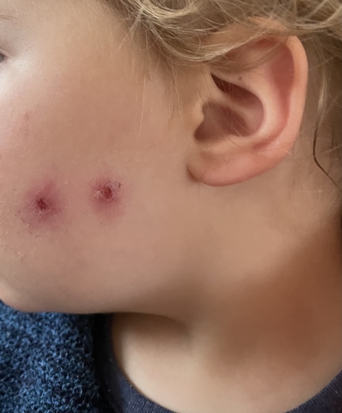 Recurrent spots on toddler’s face