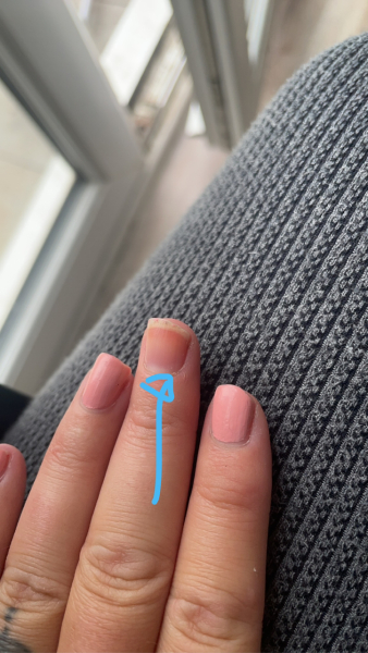 Melanoma scare advice please
