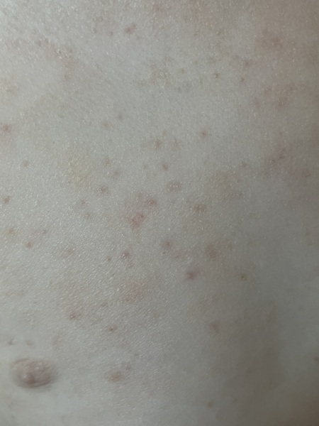 Anyone identify this rash?