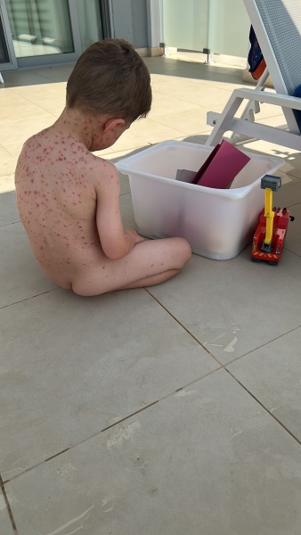 Chicken pox???