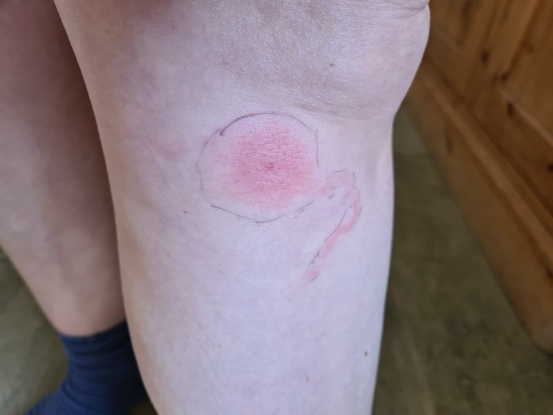 Would you be concerned by this bite?