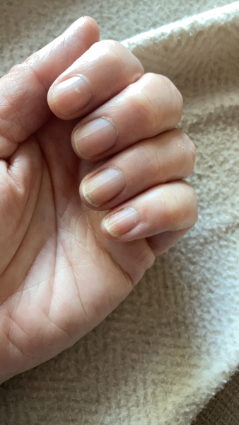 Finally stopped biting my nails