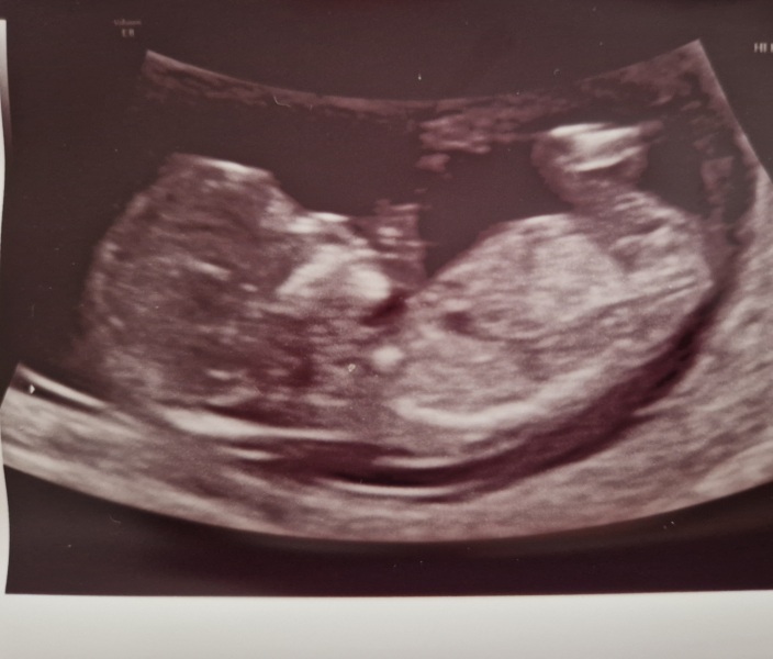 13 week scan - gender guesses?