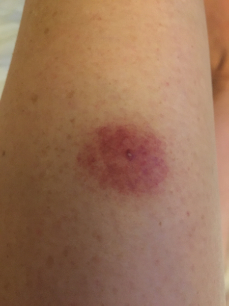 to think that mosquitos should not be a thing in the UK?