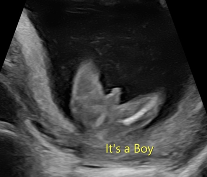 Private gender scans
