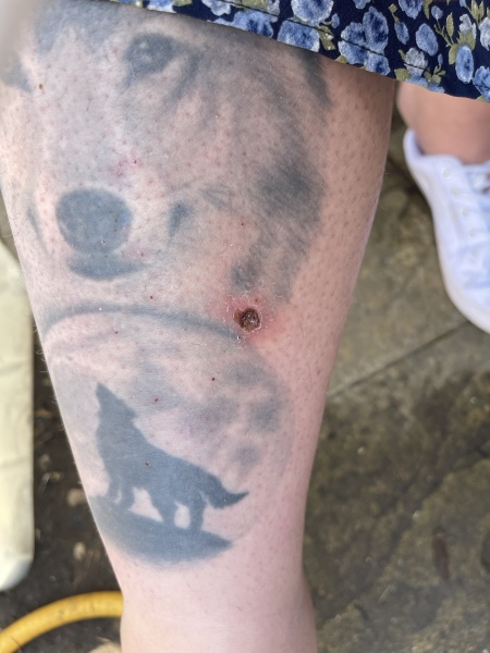 Crater-like wound on my leg turning black - what the hell is this (see pic)