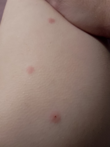 Chicken pox a second time?