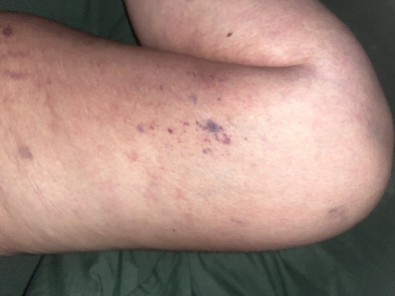Bruising