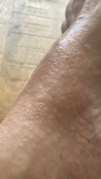 What is the rash on my foot (photo)