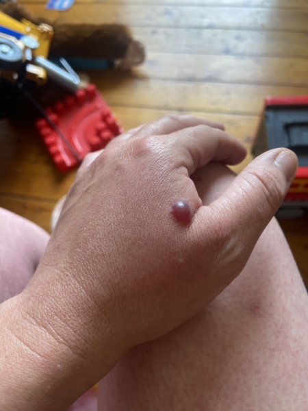 Bite, red/purple blister and swelling/nurses 