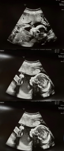 is this a normal ultrasound?