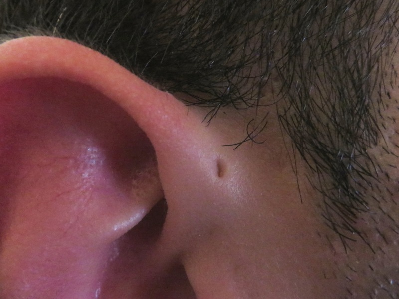 Baby has a hole in her ear