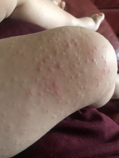 Bumps on baby.
