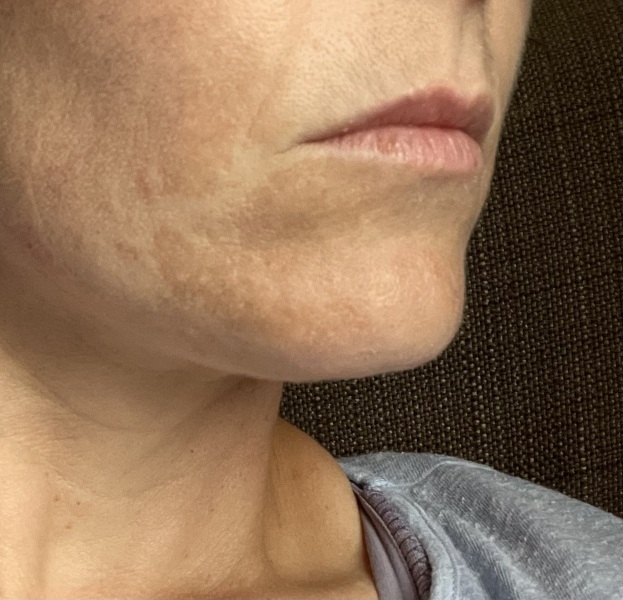 Hyperpigmentation? 