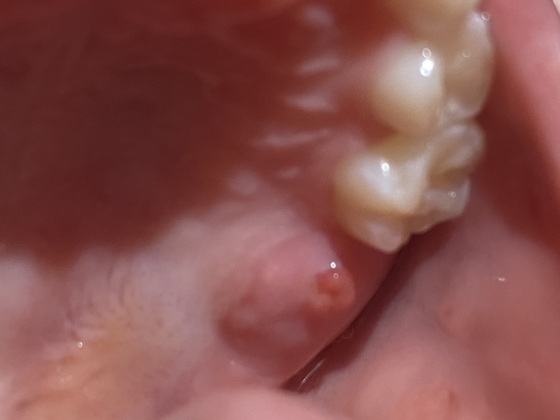 What is this on daughter’s gum? Dentists please help!