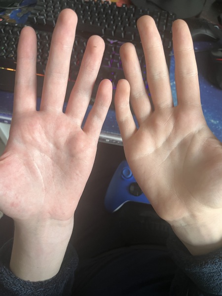 Hand and fingers all weird looking after broken wrist