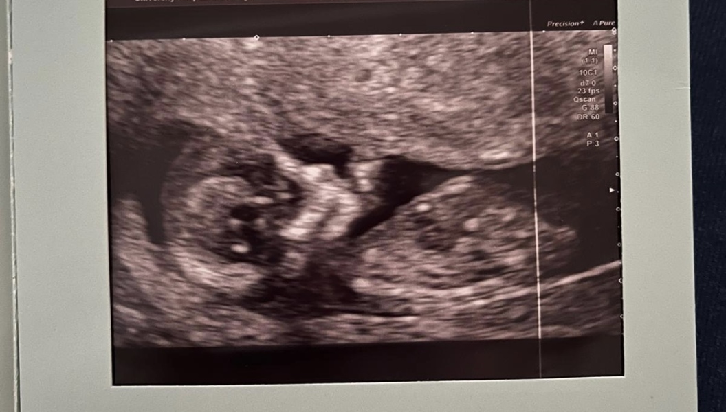 Boy or Girl? Scan photos 