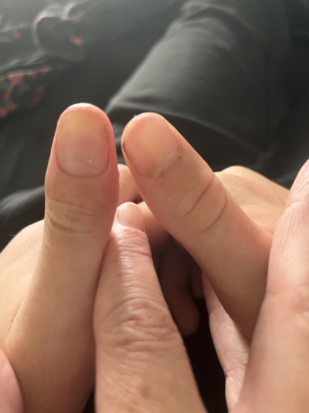 Hand and fingers all weird looking after broken wrist