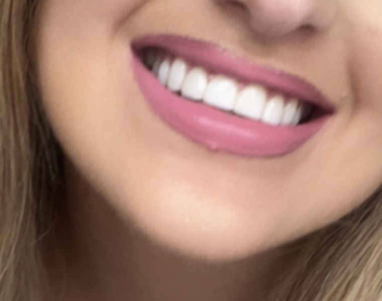 Options for neglected teeth