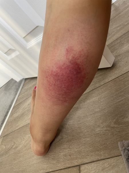 Bug bite - should I be worried???