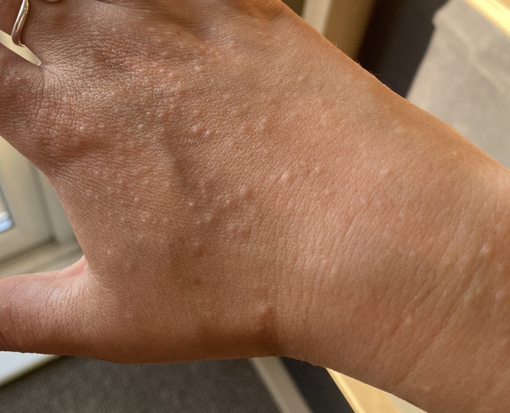 Anyone know what this rash is?