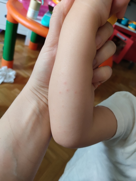 Hand-foot-mouth again? Chickenpox? (Photos)