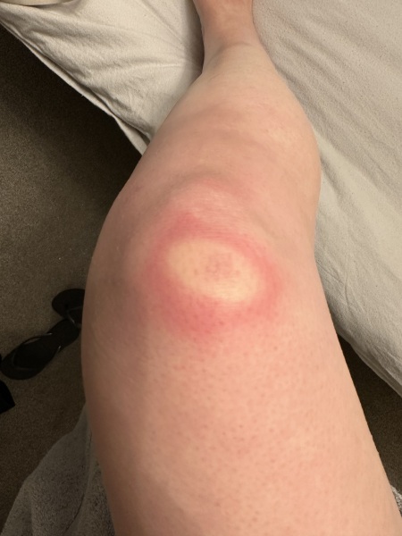 What on earth is this on my knee!!!?