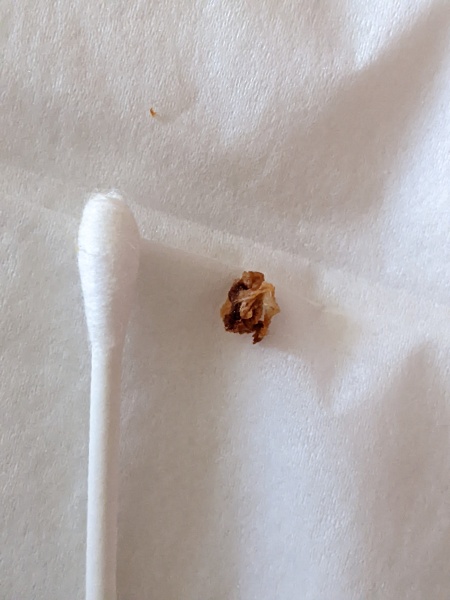 Just hooked this out of DD's ear (warning - graphic)