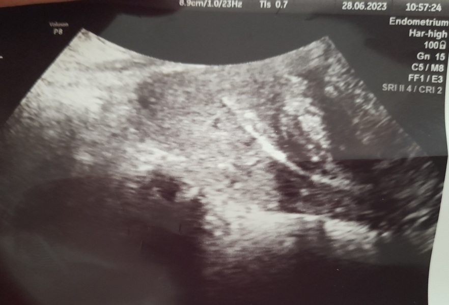 What IVF dose and how many eggs did you get?