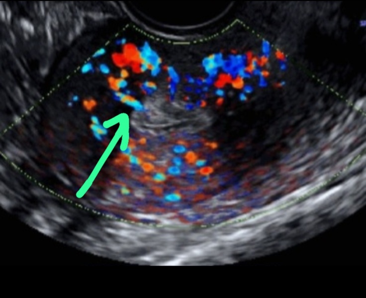 IVF April 2023