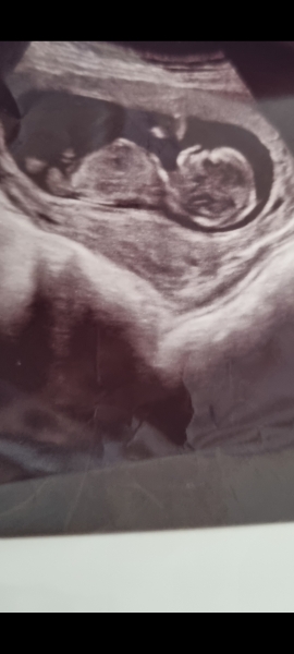 Gender guess 💖💙