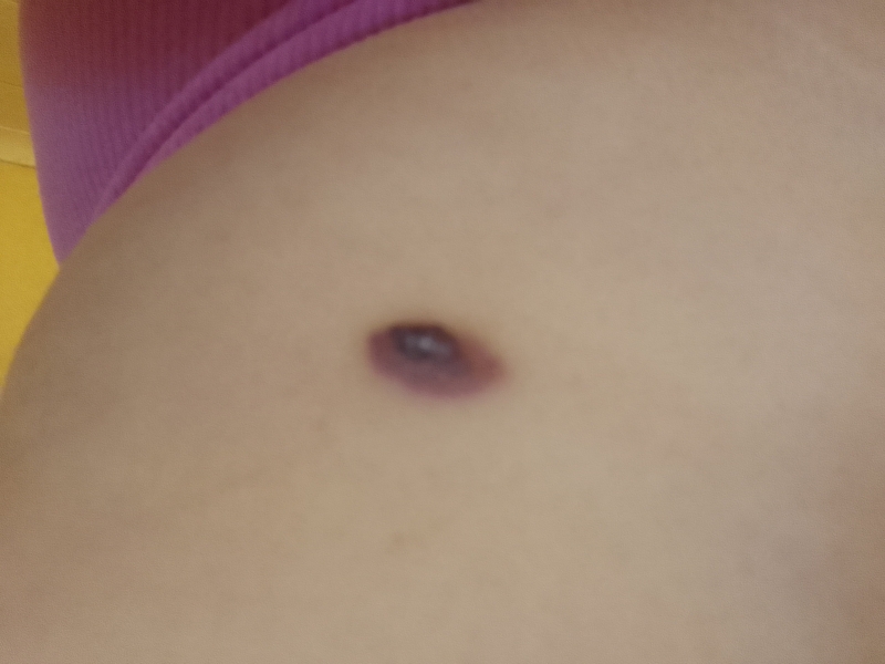 Weird Mark on my body