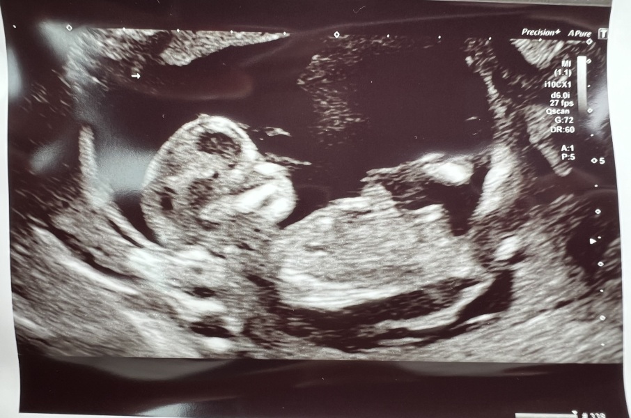 First cycle - IVF / ICSI - Day 4 