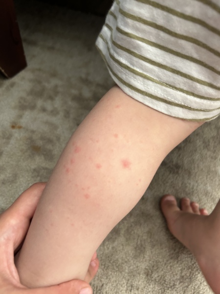 Is this chicken pox or hand foot and mouth?! 