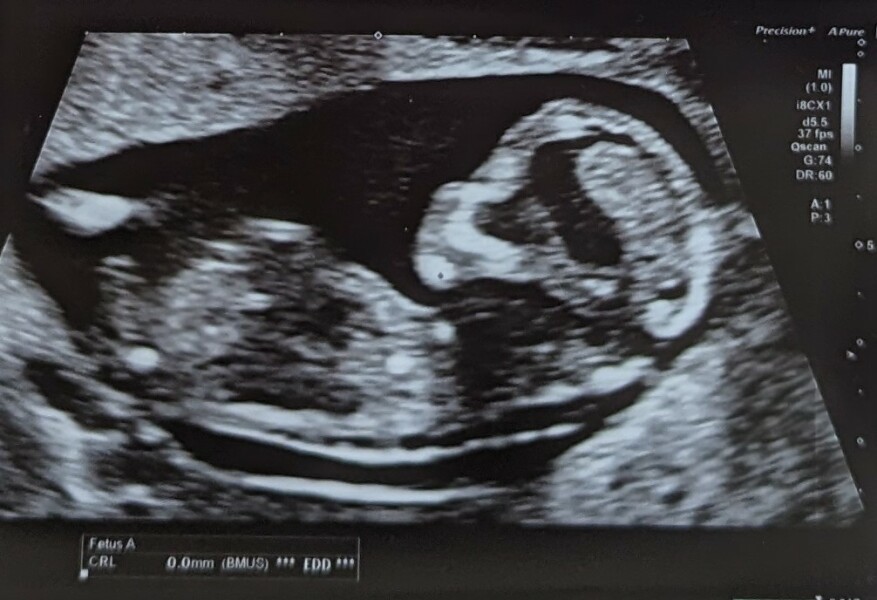 Gender guesses (scan photos included!)