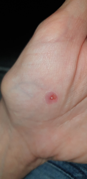 Wart help - using bazuka but it looks a bit wrong (photos)