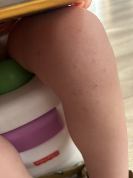 Chicken pox help ?!