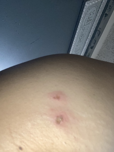 Burning rash