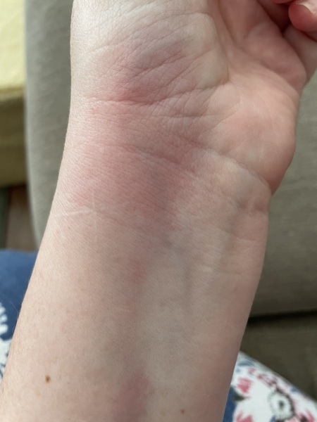 Itchy bite