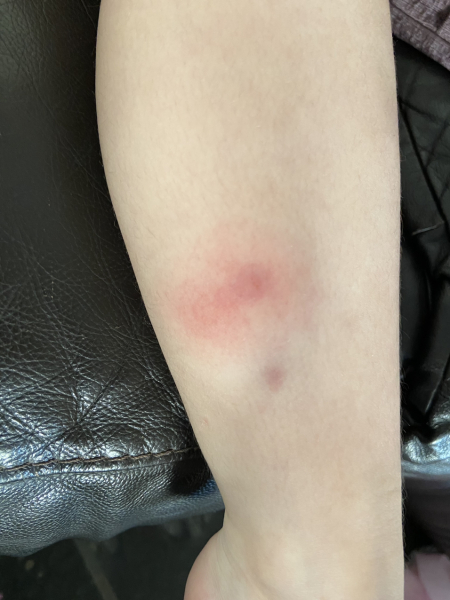 Are these tick bites?