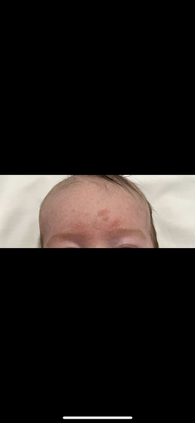 Rash on babies head 